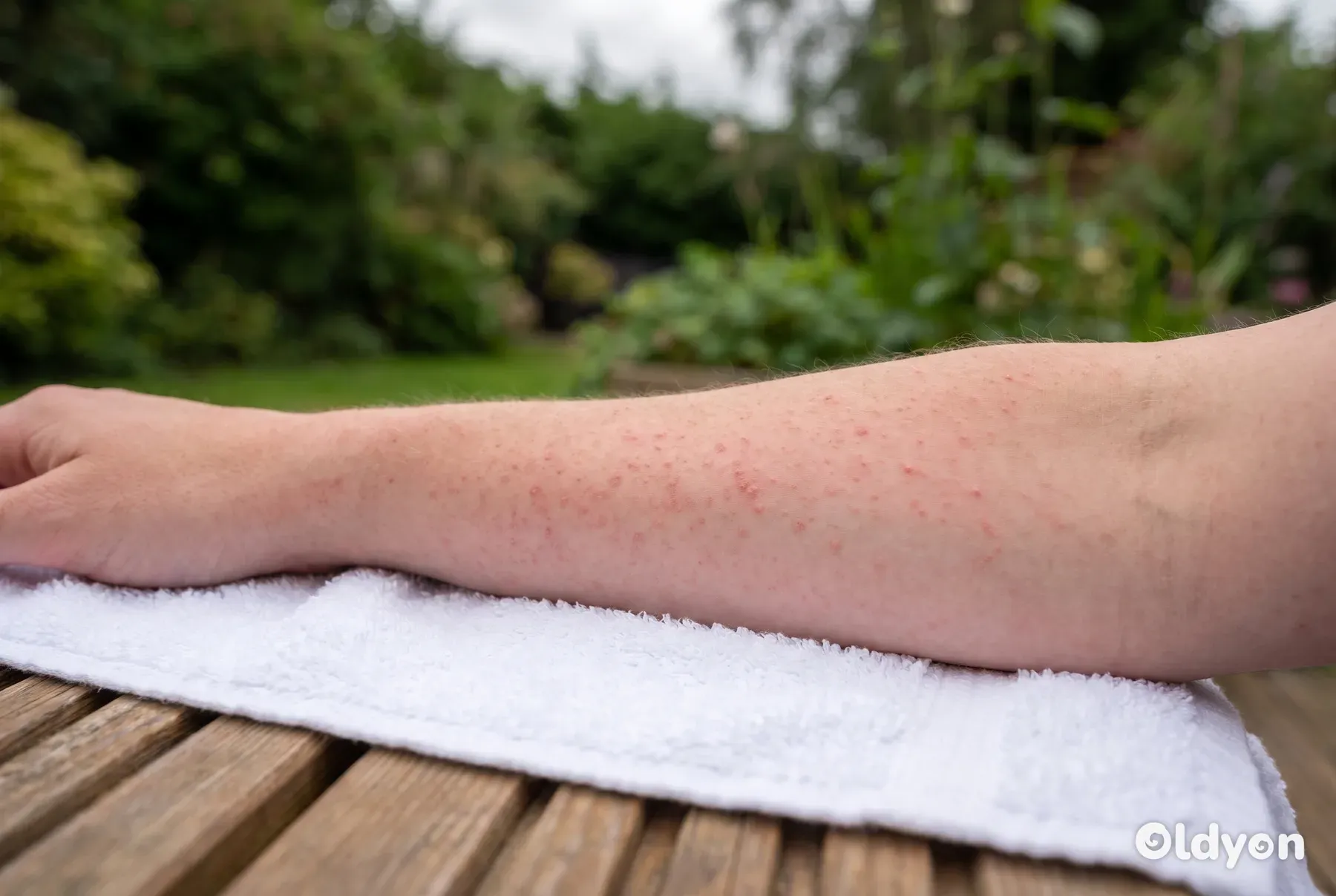 Et nærbillede af en persons underarm, der hviler på et håndklæde og viser et mildt, rødt og knoppet hududslæt.
