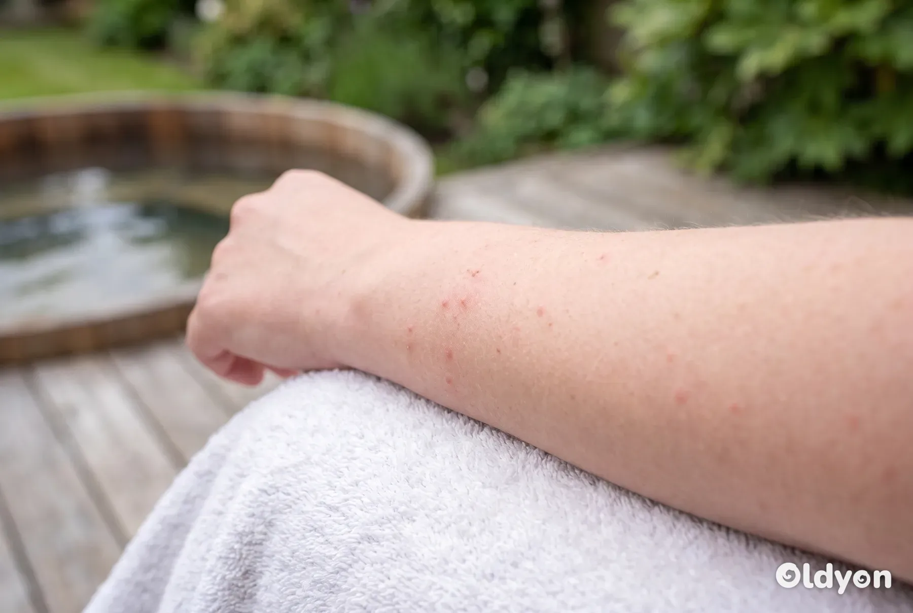 Et nærbillede af en persons underarm, der hviler på et håndklæde og viser et mildt, rødt og knoppet udslæt.